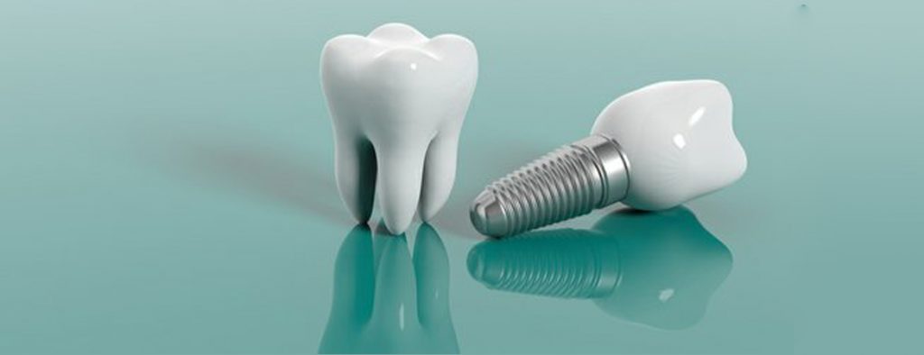 مراقبت های پس از کاشت دندانن