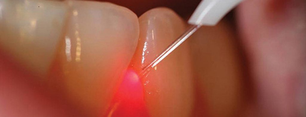 عمل جراحی با لیزر